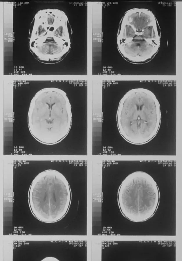 avocat-traumatisme-cranien Photographie des résultats d'une IRM cérébrale que les victimes d'un traumatisme crânien sont amenées à passer. Un avocat en droit du dommage corporel peut les aider à obtenir l'indemnisation complète de leurs préjudices.